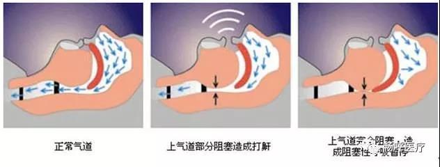 我國3000萬高血壓患者都有這毛病！你知道嗎？